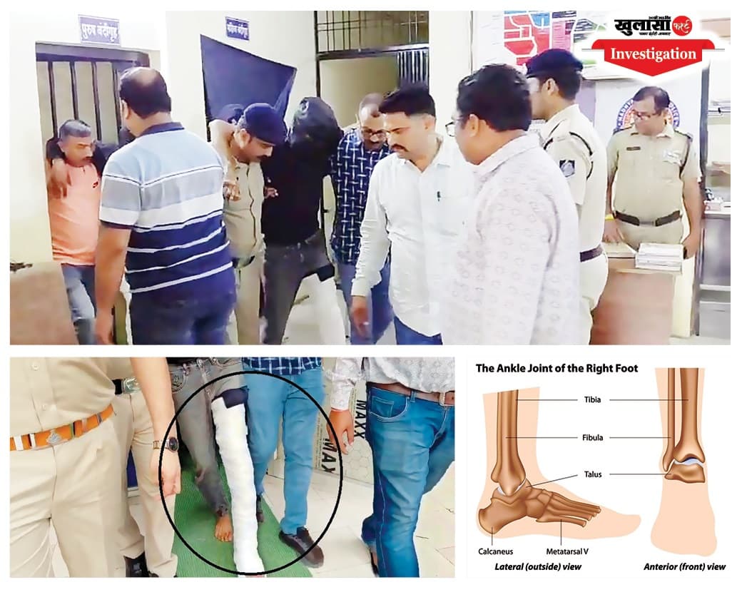 आरोपी के पैर में पट्टा, लेकिन आंखों पर पट्टी किसकी